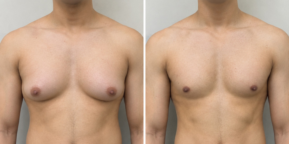 Gynecomastia Treatment in Islamabad, Pakistan: Causes, Surgery, and Recovery