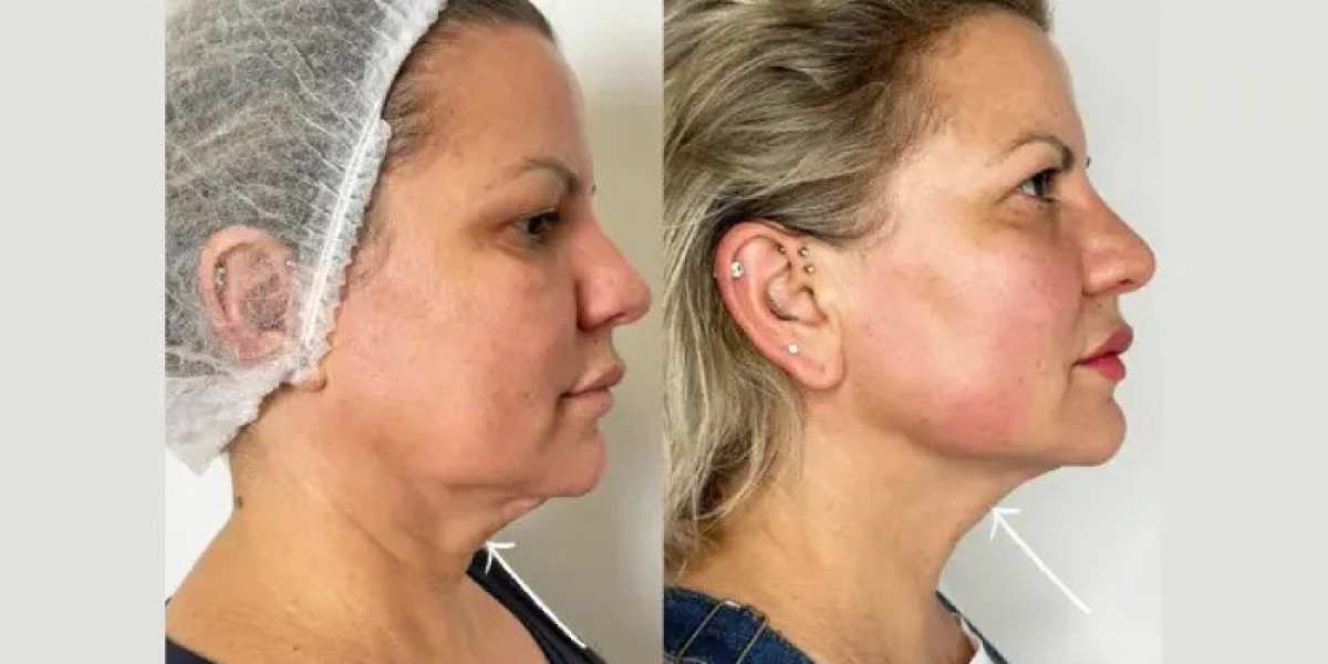 Endolift Treatment in Dubai for Advanced Neck Rejuvenation Options