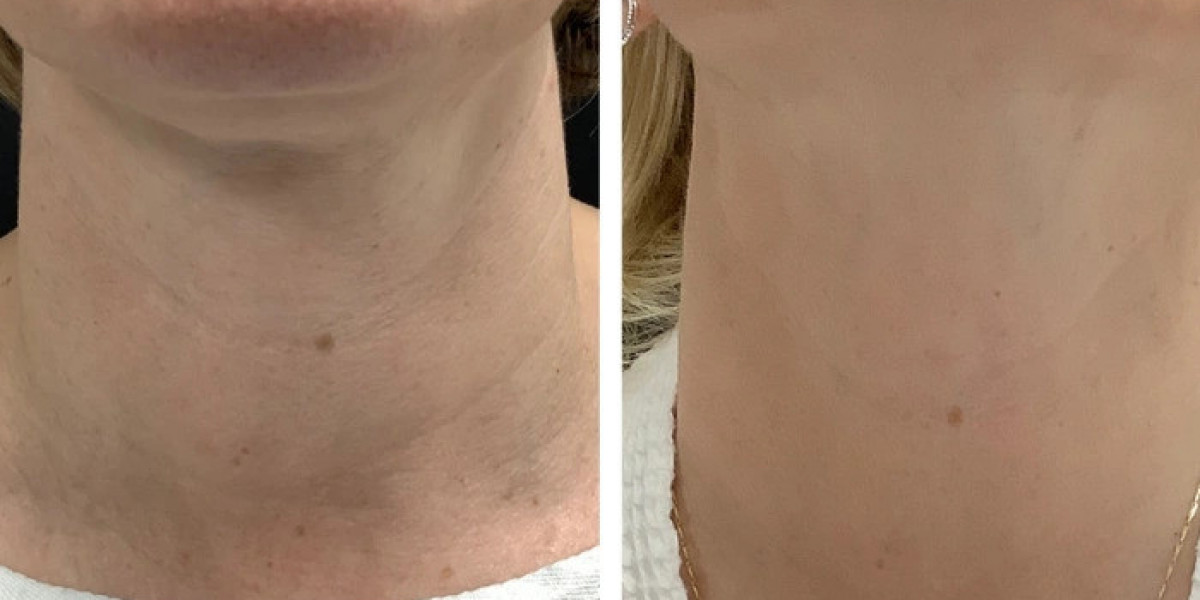 Radiofrequency (RF) Microneedling Treatment in Dubai for Enhanced Elasticity