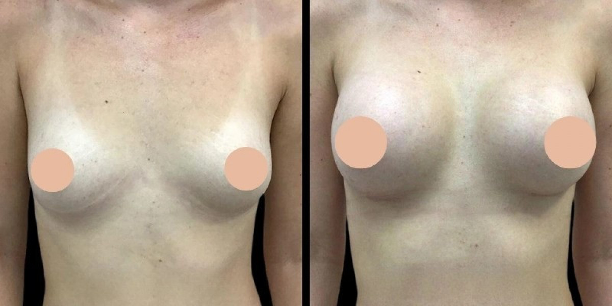 Best Breast Augmentation Surgeon in Dubai: Finding Your Ideal Implant Size